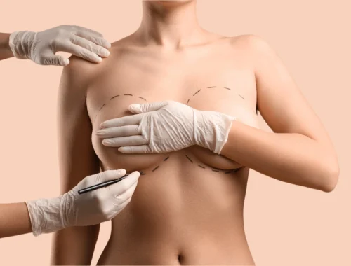 Breast-augmentation-3-1