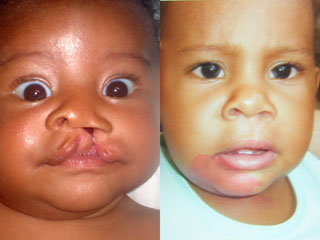 Cleft Lip Surgery Before and After Photo Patient 1